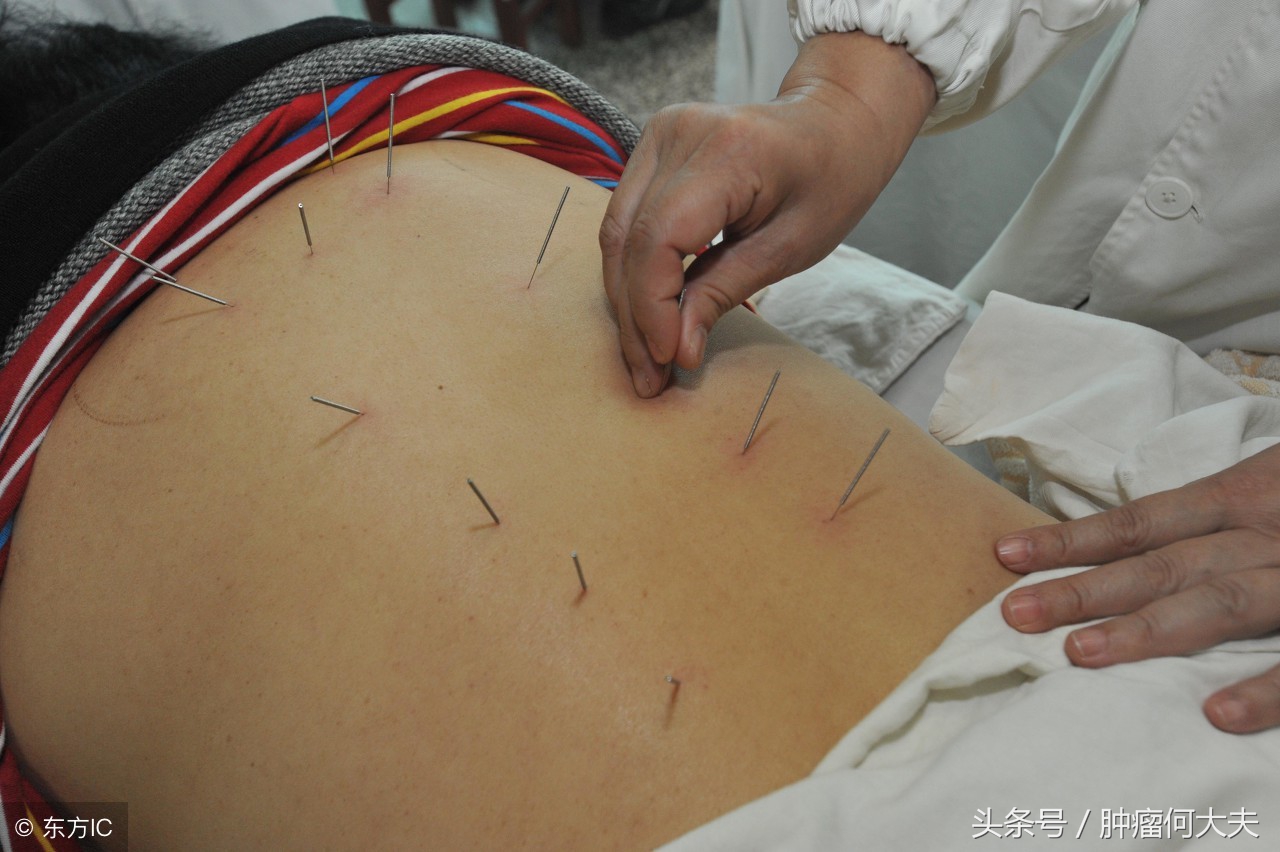 针灸治疗癌症最好的方法,针灸治疗癌症最好的穴位