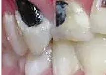 这一口烂牙，就能让你意识到*品毒**的破坏力有多恐怖