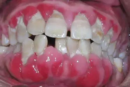 这一口烂牙，就能让你意识到*品毒**的破坏力有多恐怖