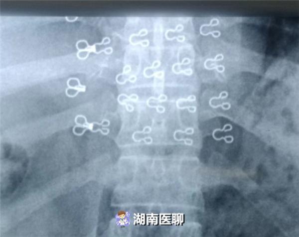 大妈摔倒路边无法动弹,70岁大妈腰直不起来