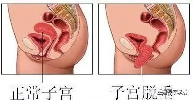 子宫的位置影响试管吗,怀孕四个月子宫位置