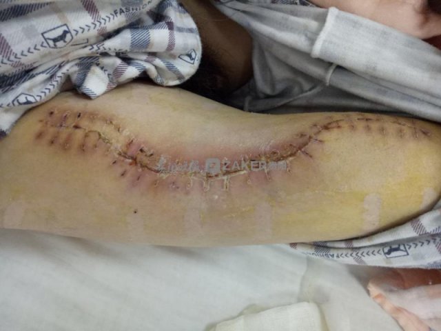 下咽癌中晚期手术,治疗下咽癌最佳疗法