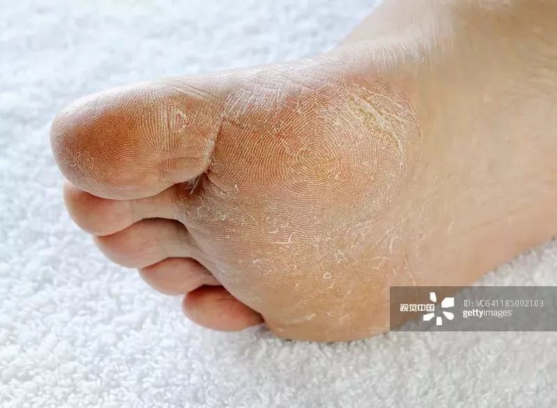 脚气奇痒难忍只需用它泡脚,去脚气脚臭痒最好最快办法