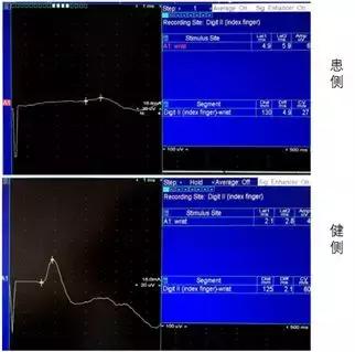 手麻、无力、肌肉萎缩？——你可能得了腕管综合征