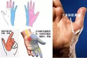 手麻、无力、肌肉萎缩？——你可能得了腕管综合征