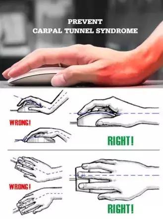 手麻、无力、肌肉萎缩？——你可能得了腕管综合征