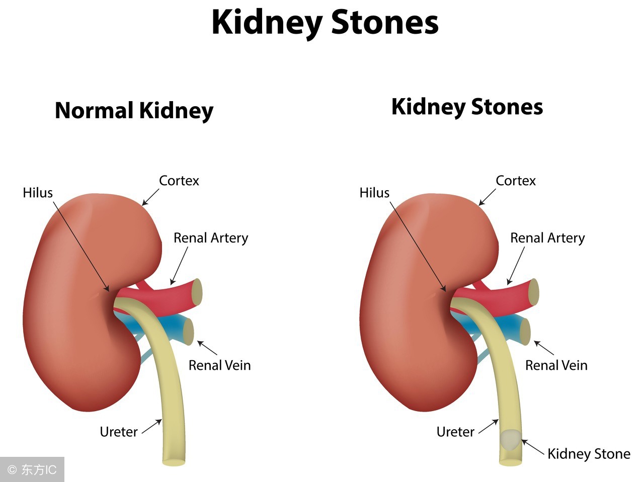 肾结石医院流程,肾结石外科治疗指南