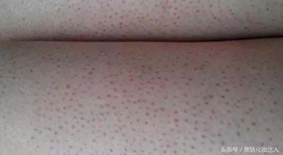 竟然连大幂幂都有解决不了的肌肤问题？