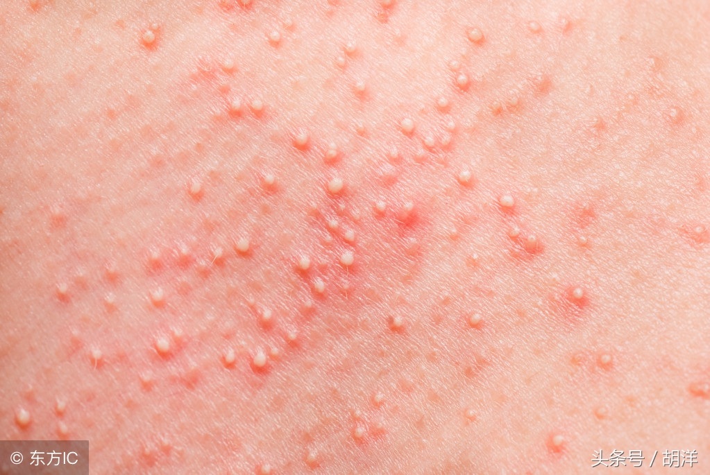 癌症特效靶向药有哪些副反应,发生副反应后如何处理,怎么避免