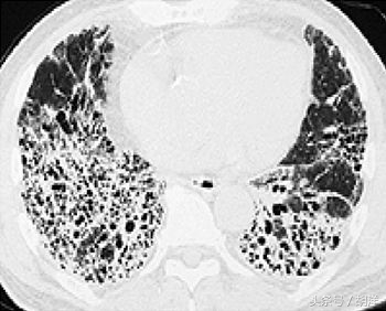 靶向药也治不好癌症吗,靶向药治疗肿瘤晚期成功率有多大