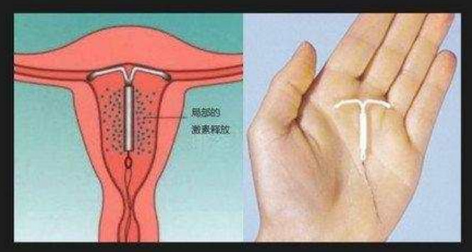 女生产后上环,女子取环6年后去医院取