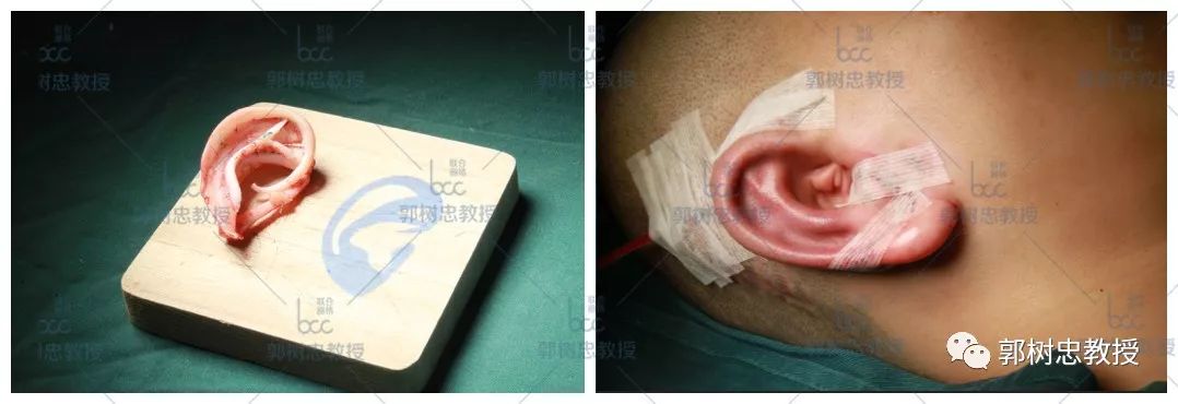 小耳症那些事儿（二十二）再造耳朵的厚度