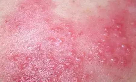 带状疱疹消退后长了很多小痘痘,治疗带状疱疹的经历