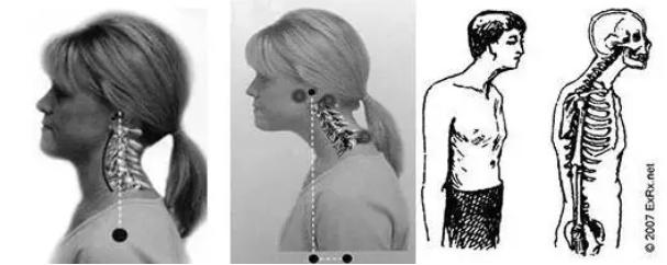 滑肩富贵包快速消除方法,厚背圆肩富贵包怎么消除