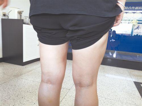 女子*款贷**5万抽脂减肥，术后一年身材走样，美容院：抽脂只能塑性