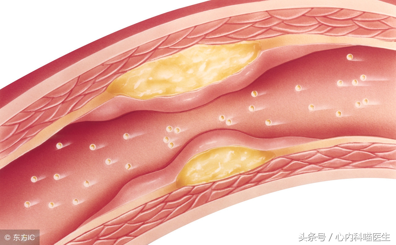 长期药物治疗可以减轻冠状动脉狭窄、减少心绞痛和心梗发生