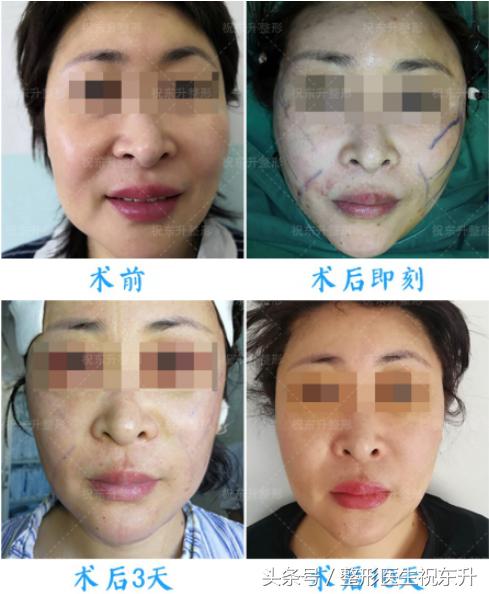 25岁脸皮肤松弛该怎么改善,脸皮肤松垮怎么补救