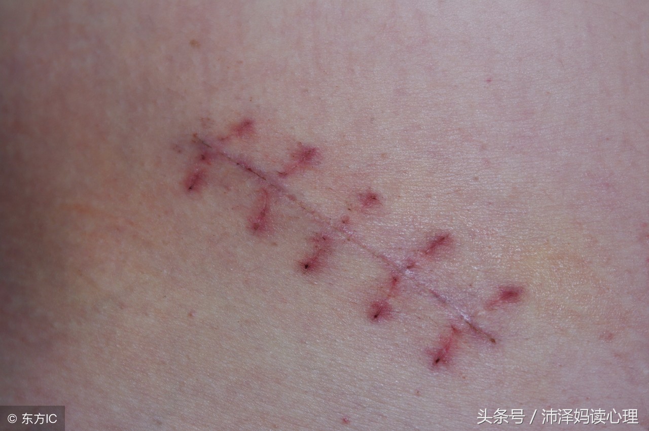 剖宫产与顺产最大区别,剖宫产和剖腹产的危险性