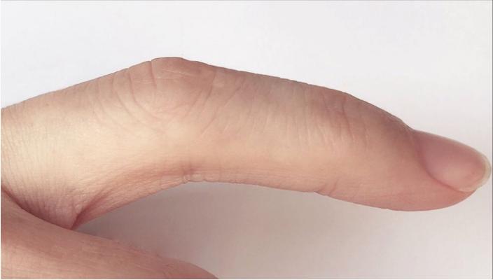 手上长很痒的小包是怎么回事,手上长的汗疱疹怎么快速止痒