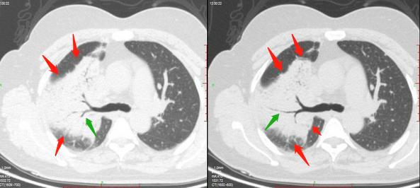 13岁女孩咳嗽半个月确定肺癌,咳嗽一个多月肺癌还有救吗