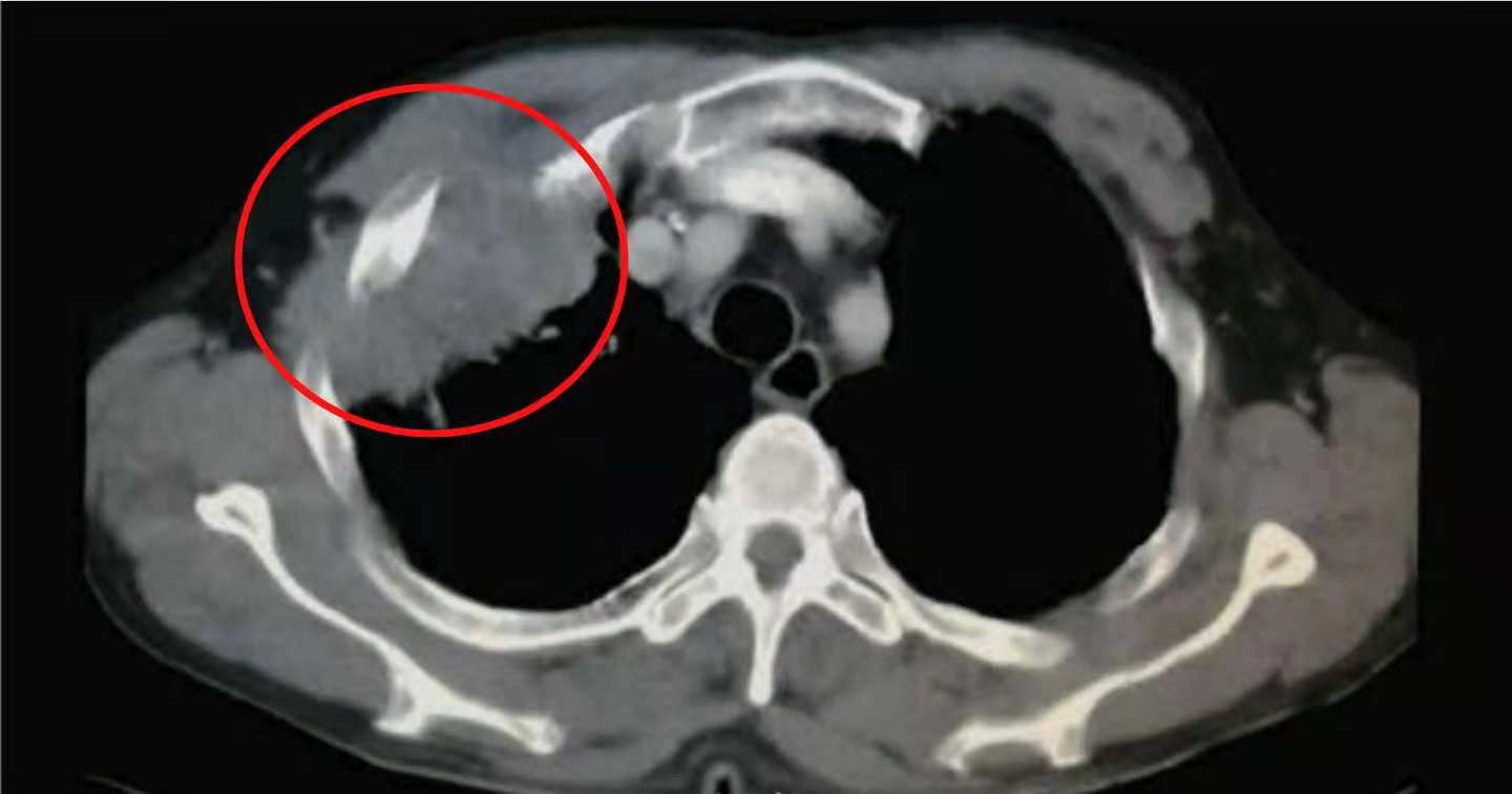 13岁女孩咳嗽半个月确定肺癌,咳嗽一个多月肺癌还有救吗
