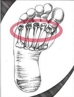 脚上有三颗小洞又疼又痒怎么办,脚上磨出了红点很痛怎么办