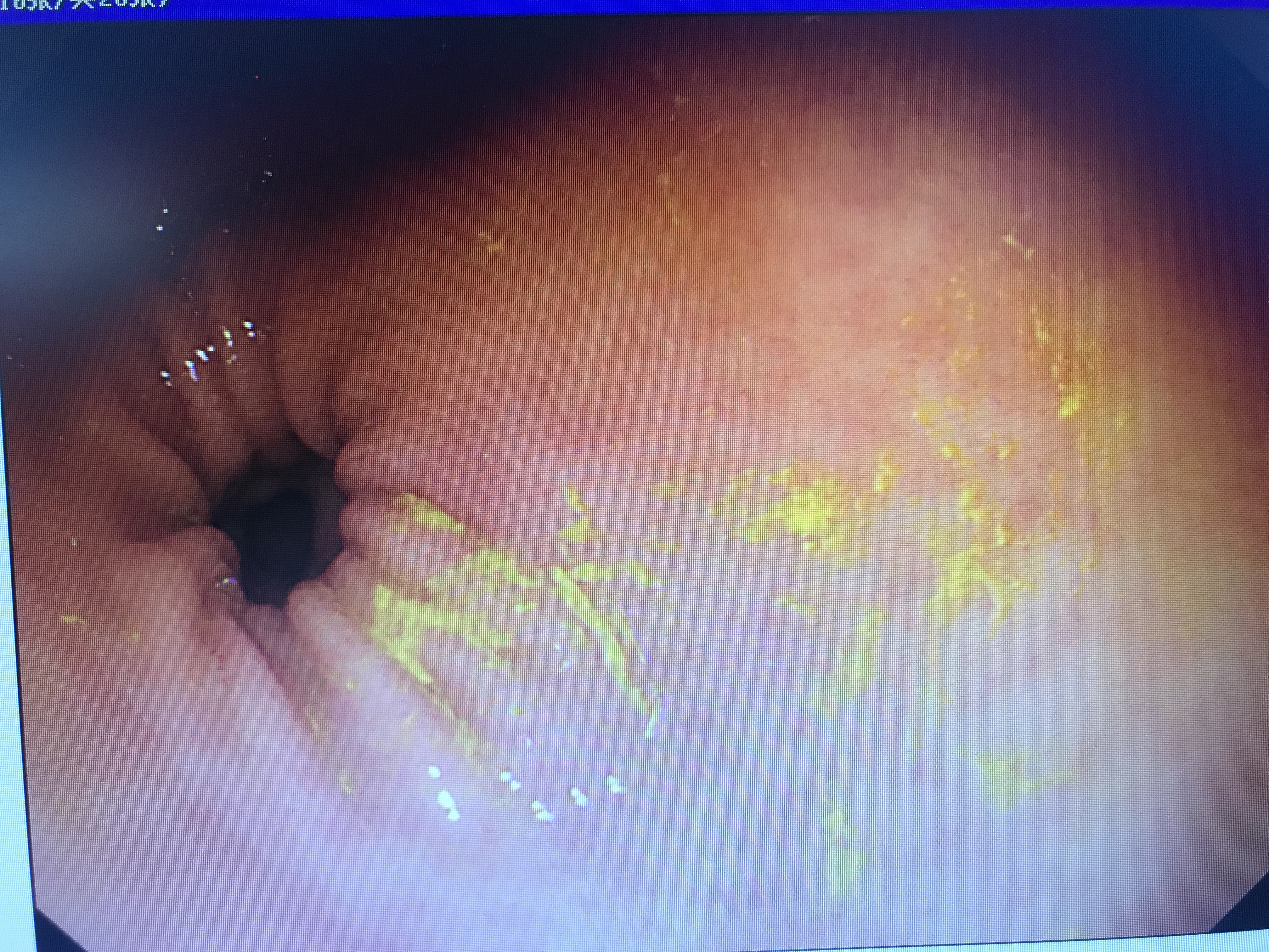 儿童不停的咳嗽最快的见效药,儿童慢性咳嗽的诊断及治疗
