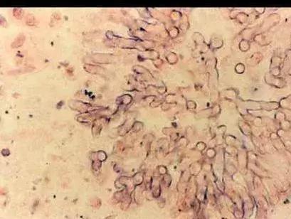 为啥会得霉菌性外阴炎,为什么会得霉菌性外阴炎