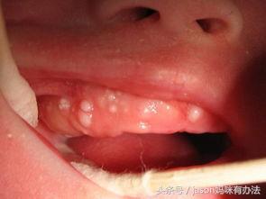 新生儿黄疸需要就医吗,新生儿黄疸照蓝光又反复咋办