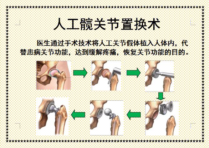 人工髋关节置换术前准备护理,人工髋关节置换术的健康宣教手册