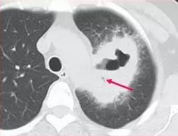 73岁老人肺上长3个结节有事吗,70多岁老人肺部有个拳头大的肿块