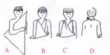 三角巾的包扎使用方法视频,风帽式三角巾包扎