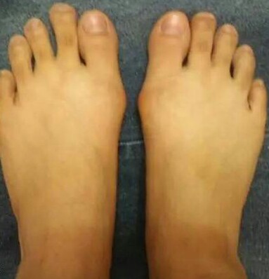 轻中度拇外翻如何矫正,趾外翻是什么引起的