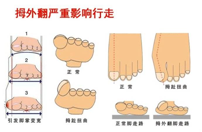 轻中度拇外翻如何矫正,趾外翻是什么引起的