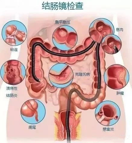 胃镜检查胶囊内镜好吗,胃镜胶囊胃镜钡餐有什么区别