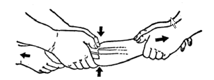中医骨折治疗原则,中医骨伤整复术