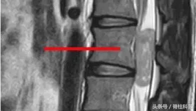 腰腿疼的防治误区,腰腿侧边疼怎么自测