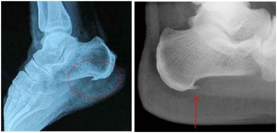 脚后跟长骨刺非常痛应该怎么治疗,脚后跟长骨刺了特别疼怎么治疗
