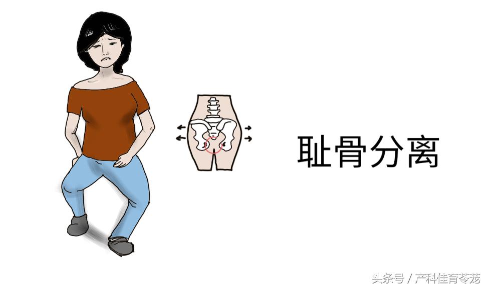 剖宫产辟谣,腹膜外剖宫产辟谣