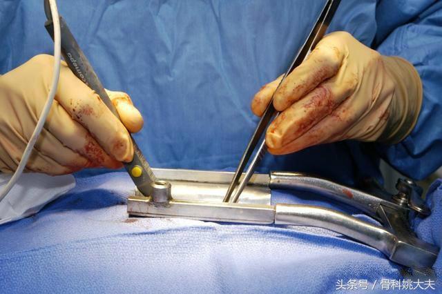 血管破裂如何快速止血,不小心把血管剪破怎么止血