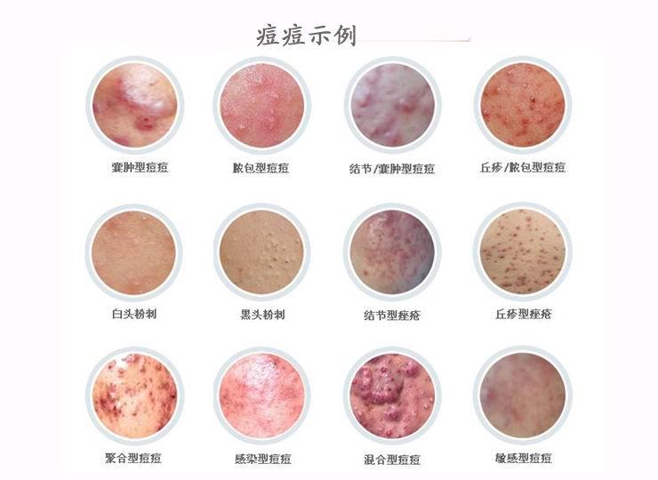 寻常疮怎么治,寻常痤疮用什么药膏