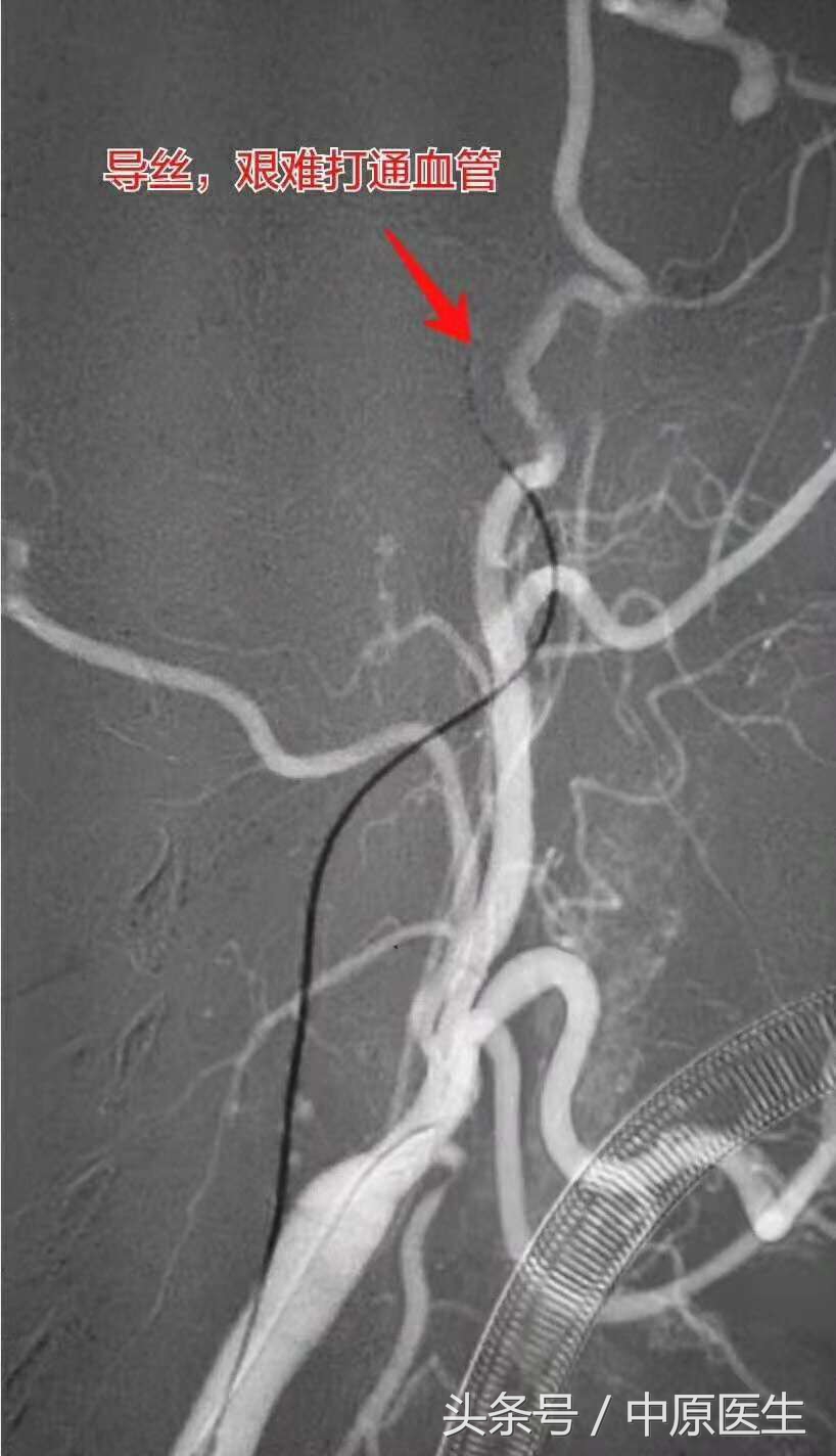 53岁男子脑梗急救室抢救真实纪实,脑动脉闭塞介入治疗视频