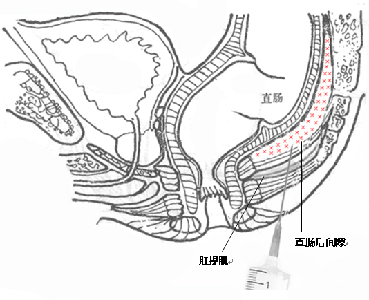 「中医适宜技术」第九篇肛肠类技术｜第5章注射固脱