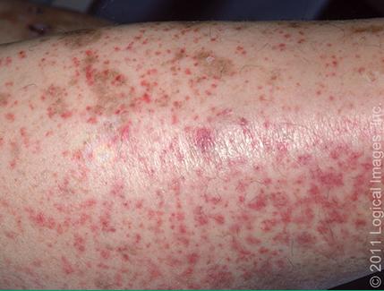 肌肉骨骼疾病的表现是什么,出现骨头疼会是癌吗