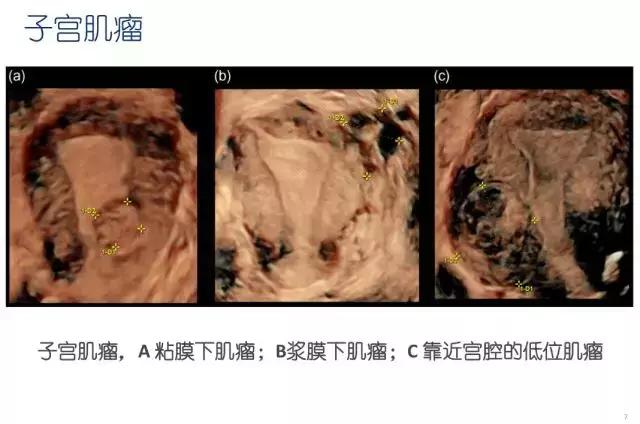 妇科盆腔彩超探头,妇科超声波探头