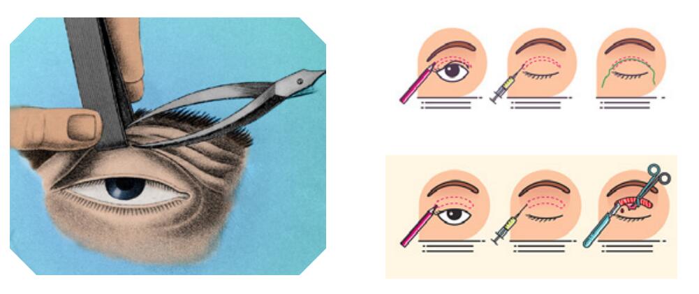 双眼皮整形的几种眼睛形状,下三白眼怎么做双眼皮手术矫正