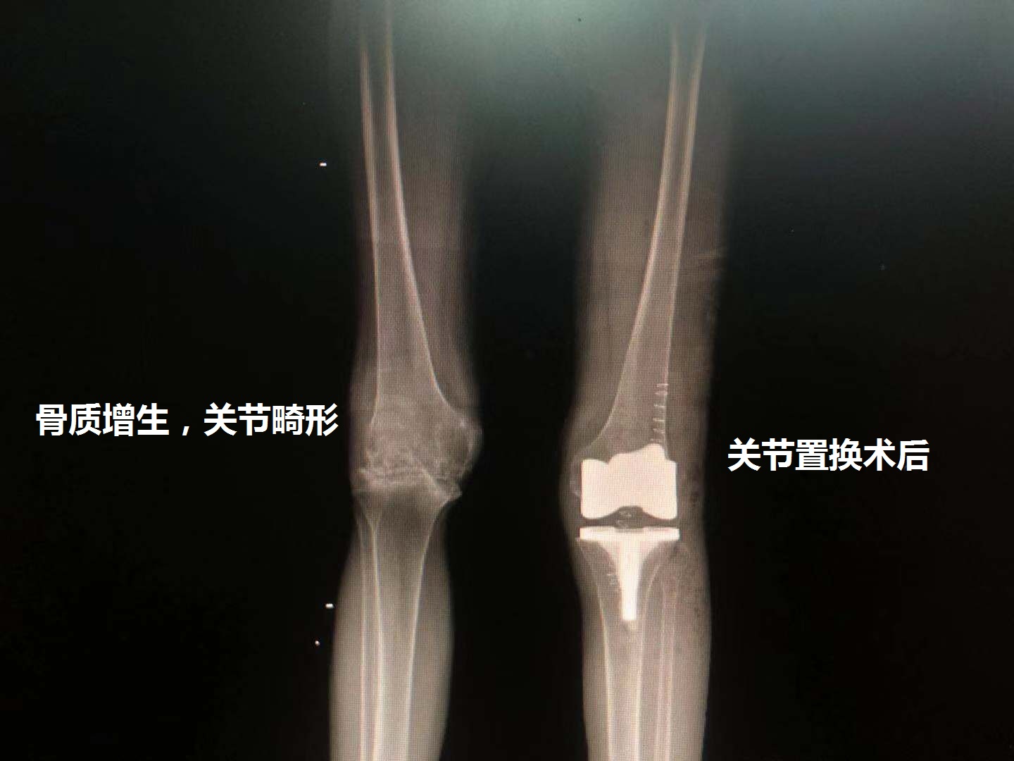 老年人骨质增生的症状和治疗方法,老年人腰部骨质增生怎么治疗最好