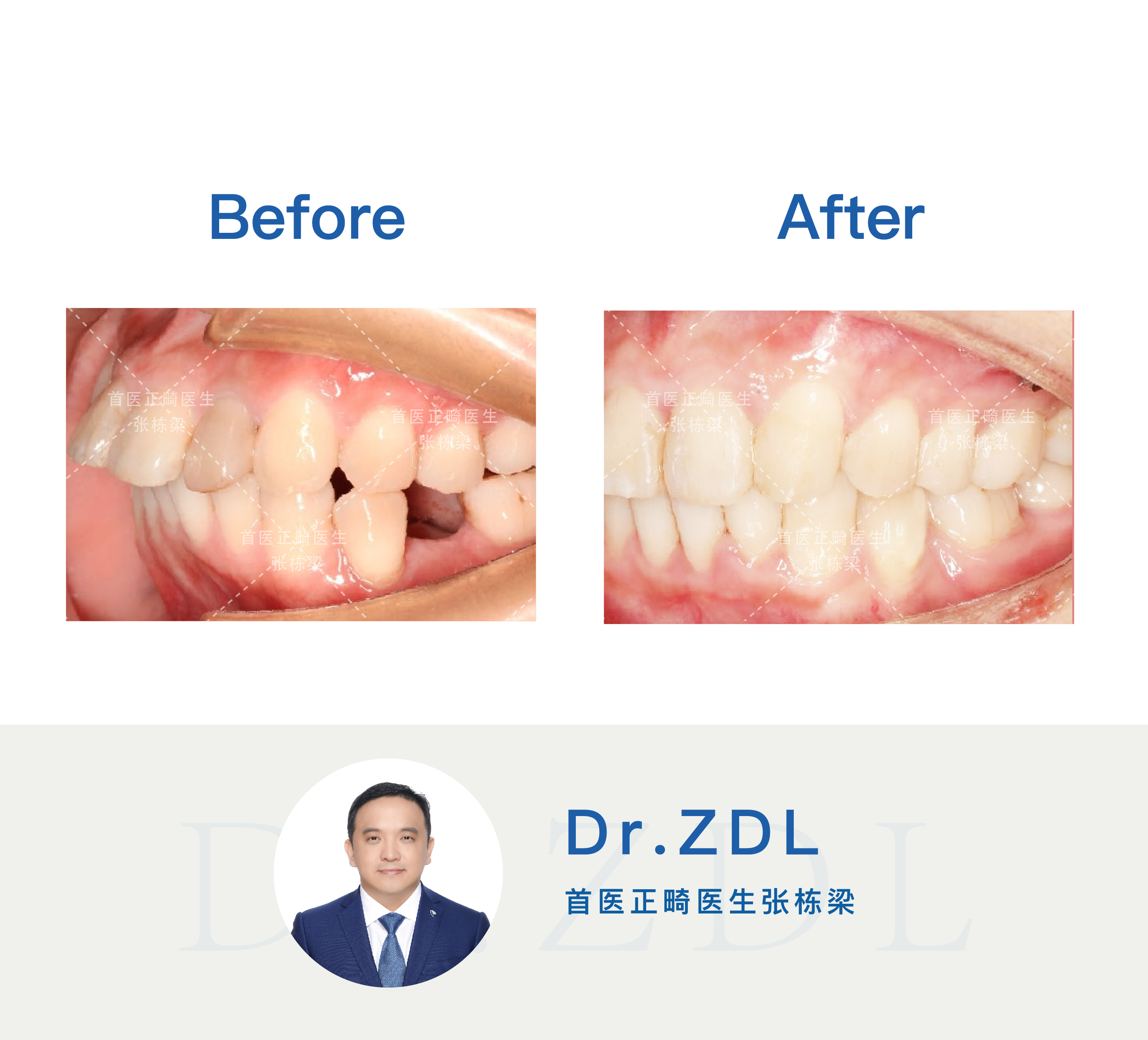 24岁戴牙套矫正效果能有效吗,40岁戴隐形牙套矫正牙齿经历