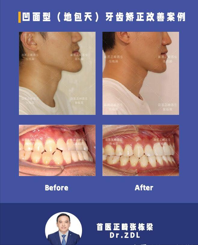 戴牙套矫正牙齿脸型会变好看吗,隐形牙套矫正后脸型变化