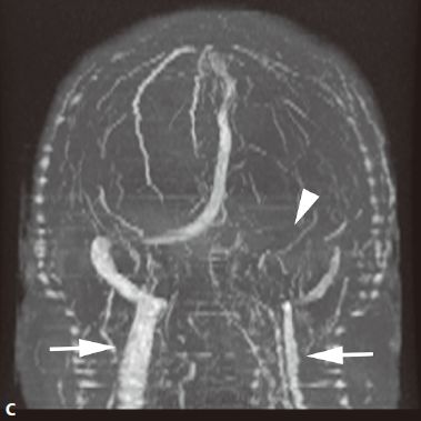 颅内血管周围间隙的影像鉴别,颅脑血管源性疾病影像诊断